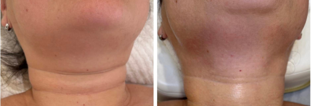 Antes e depois K-Shot
