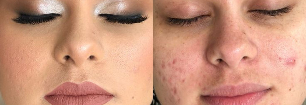 Antes e depois Plasma com Células-Tronco